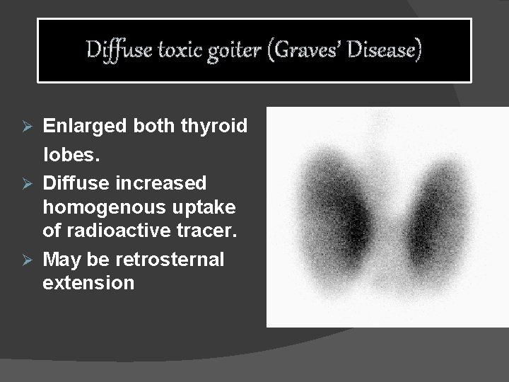 Diffuse toxic goiter (Graves’ Disease) Enlarged both thyroid lobes. Ø Diffuse increased homogenous uptake