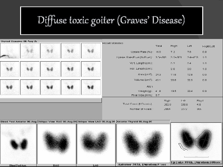 Diffuse toxic goiter (Graves’ Disease) 