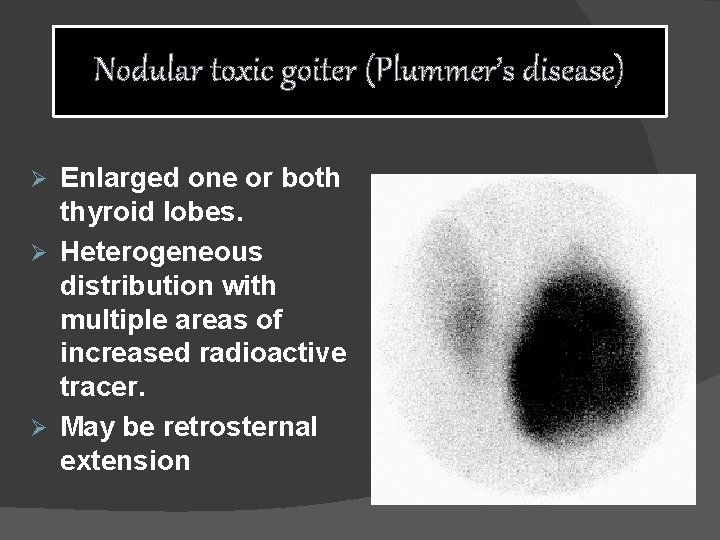 Nodular toxic goiter (Plummer’s disease) Enlarged one or both thyroid lobes. Ø Heterogeneous distribution