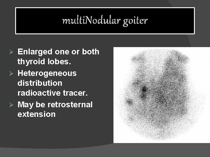 multi. Nodular goiter Enlarged one or both thyroid lobes. Ø Heterogeneous distribution radioactive tracer.