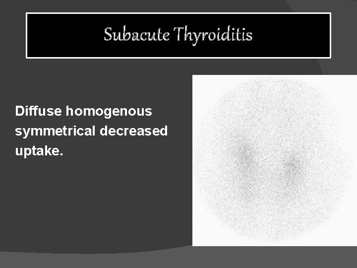 Subacute Thyroiditis Diffuse homogenous symmetrical decreased uptake. 