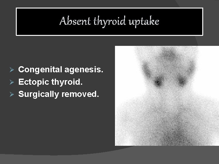 Absent thyroid uptake Congenital agenesis. Ø Ectopic thyroid. Ø Surgically removed. Ø 