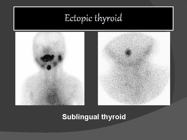 Ectopic thyroid Sublingual thyroid 