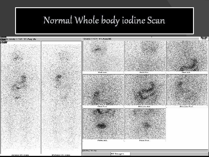 Normal Whole body iodine Scan 