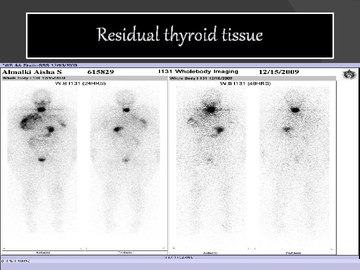 Residual thyroid tissue 