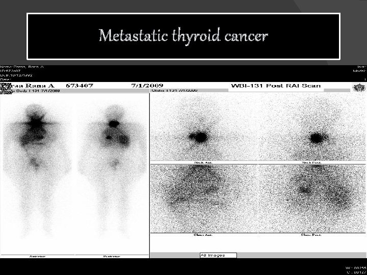 Metastatic thyroid cancer 