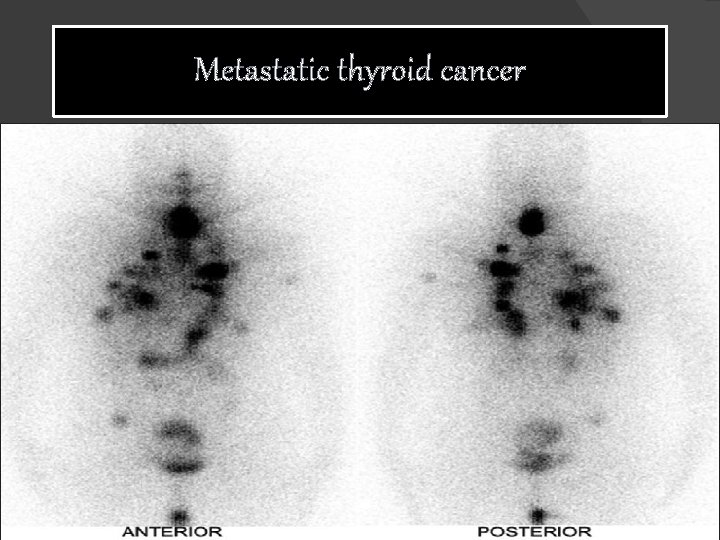 Metastatic thyroid cancer 