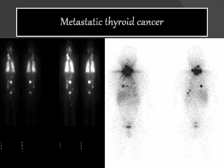 Metastatic thyroid cancer 