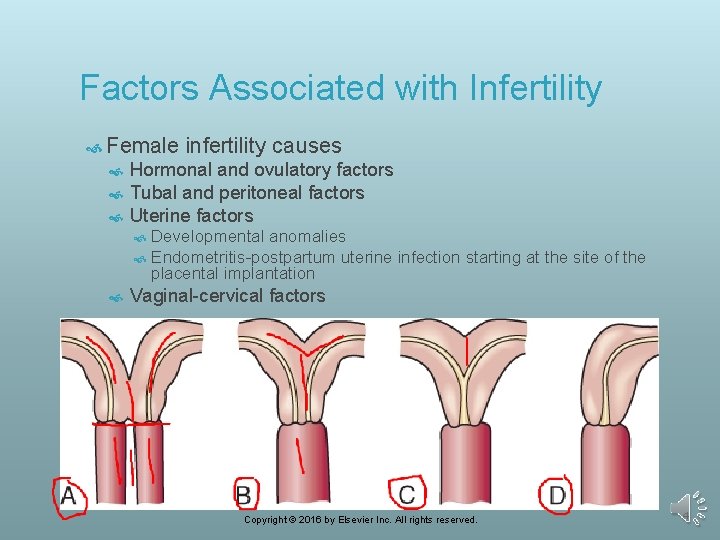 Factors Associated with Infertility Female infertility causes Hormonal and ovulatory factors Tubal and peritoneal