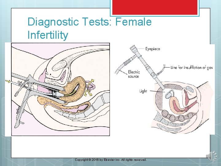 Diagnostic Tests: Female Infertility Copyright © 2016 by Elsevier Inc. All rights reserved. 7