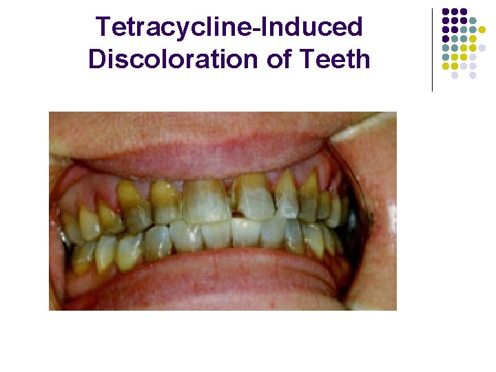 Tetracycline-Induced Discoloration of Teeth 