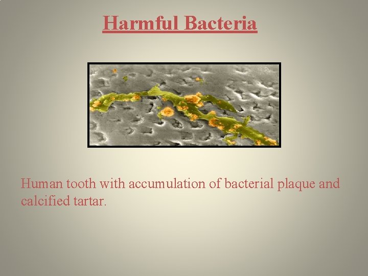 Harmful Bacteria Human tooth with accumulation of bacterial plaque and calcified tartar. 