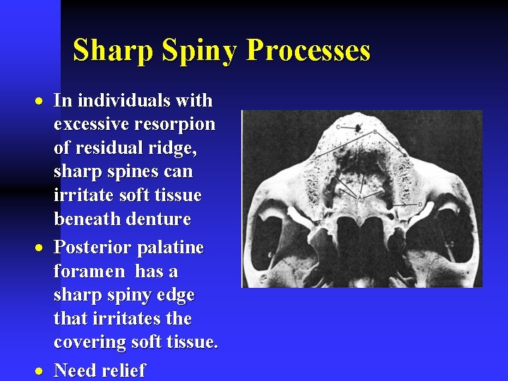 Sharp Spiny Processes · In individuals with excessive resorpion of residual ridge, sharp spines