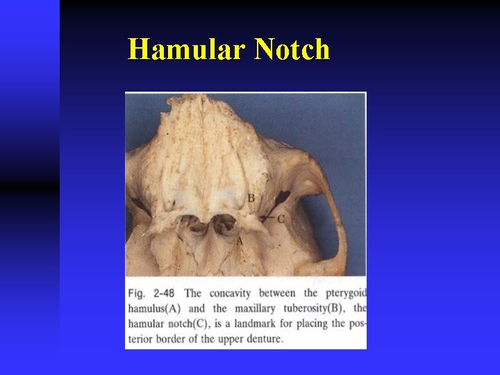 Hamular Notch 
