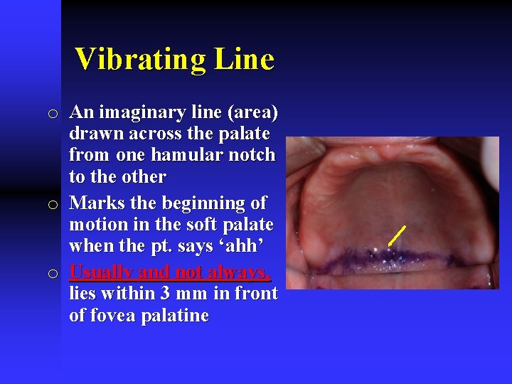 Vibrating Line o An imaginary line (area) drawn across the palate from one hamular
