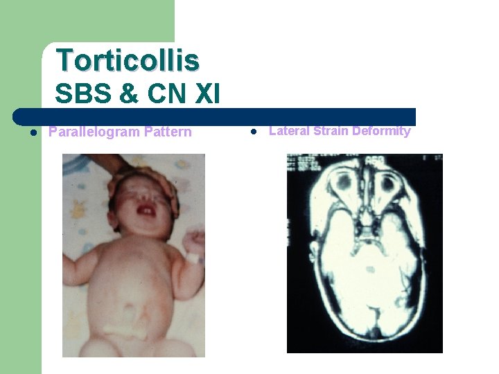 Torticollis SBS & CN XI l Parallelogram Pattern l Lateral Strain Deformity 