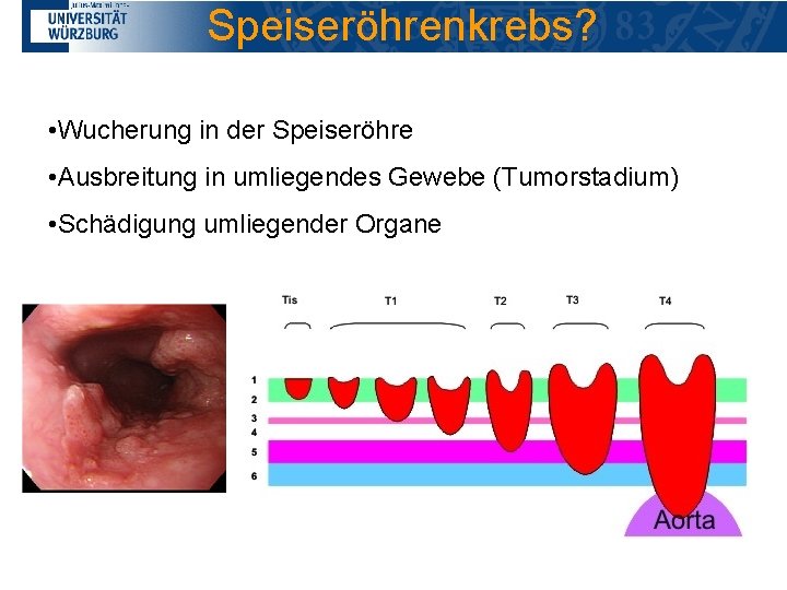 Speiseröhrenkrebs? • Wucherung in der Speiseröhre • Ausbreitung in umliegendes Gewebe (Tumorstadium) • Schädigung