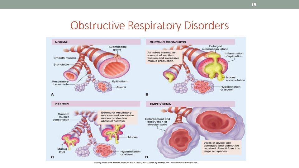 18 Obstructive Respiratory Disorders 
