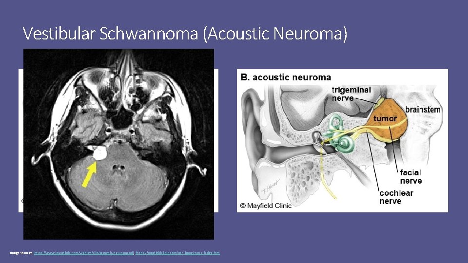 Vestibular Schwannoma (Acoustic Neuroma) Image sources: https: //www. iowaclinic. com/webres/File/acoustic-neuroma. pdf, https: //mayfieldclinic. com/mc_hope/story_haley.