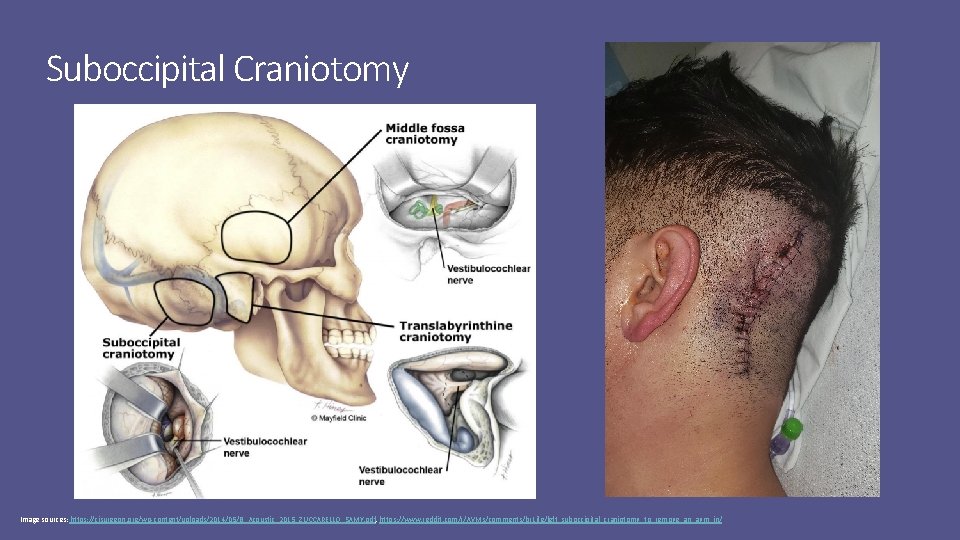 Suboccipital Craniotomy Image sources: https: //cisurgeon. org/wp-content/uploads/2014/05/B_Acoustic_2015_ZUCCARELLO_SAMY. pdf, https: //www. reddit. com/r/AVMs/comments/br 1 ife/left_suboccipital_craniotomy_to_remove_an_avm_in/