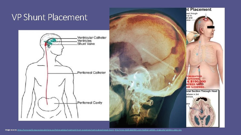 VP Shunt Placement Image sources: https: //www. pacificneuroscienceinstitute. org/hydrocephalus/treatment/shunt-procedures/ventriculoperitoneal-shunt/, http: //www. medicalexhibits. com/medical_exhibits_image. php?