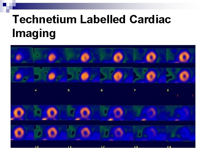 Technetium Labelled Cardiac Imaging 