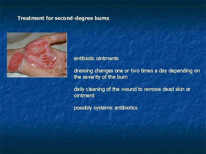 Treatment for second-degree burns antibiotic ointments dressing changes one or two times a day