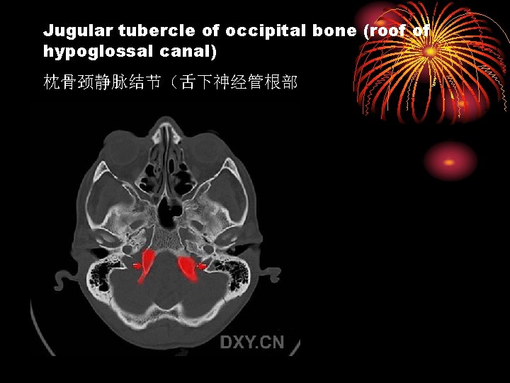 Jugular tubercle of occipital bone (roof of hypoglossal canal) 枕骨颈静脉结节（舌下神经管根部 