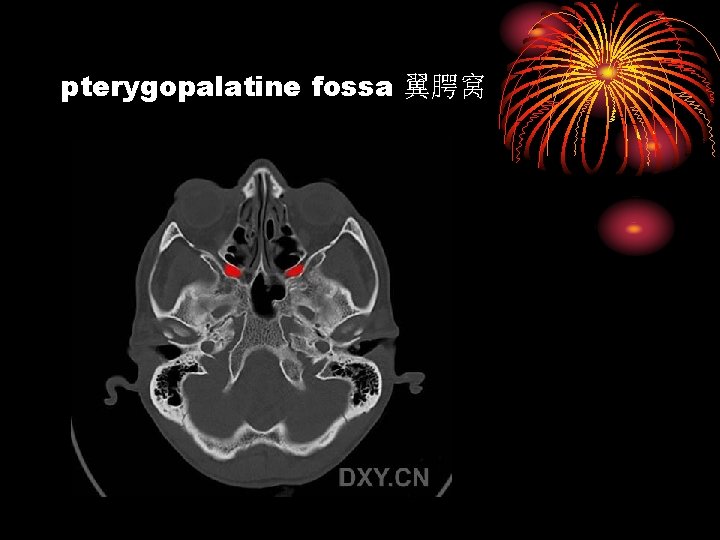 pterygopalatine fossa 翼腭窝 