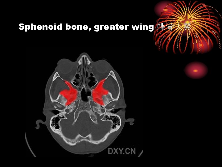 Sphenoid bone, greater wing 蝶骨大翼 