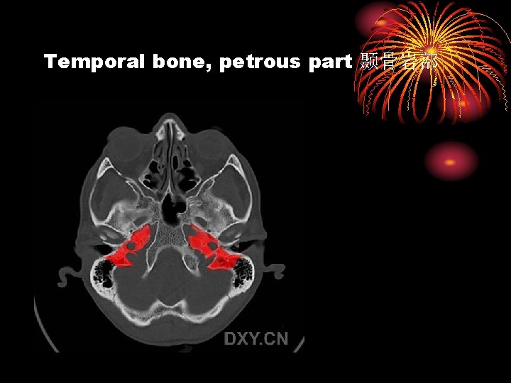 Temporal bone, petrous part 颞骨岩部 