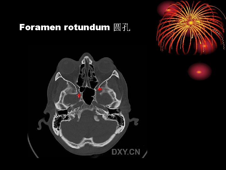 Foramen rotundum 圆孔 