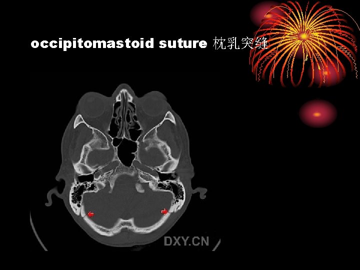 occipitomastoid suture 枕乳突缝 