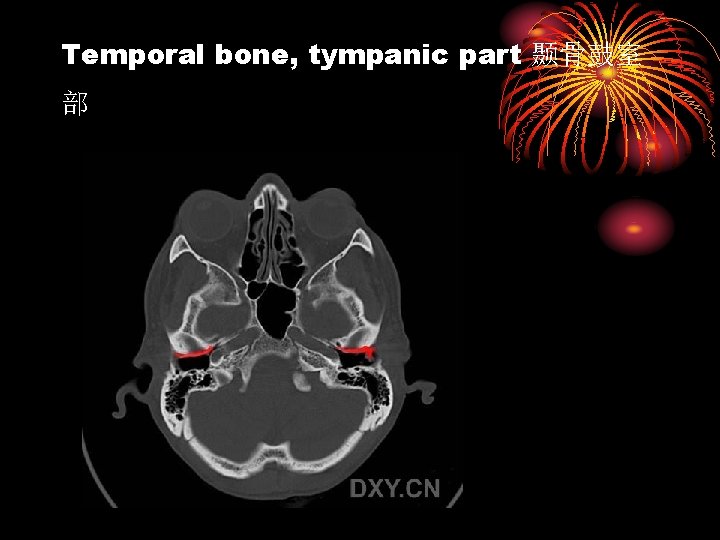 Temporal bone, tympanic part 颞骨鼓室 部 