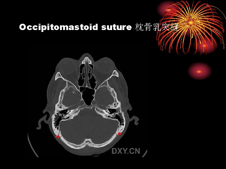 Occipitomastoid suture 枕骨乳突缝 