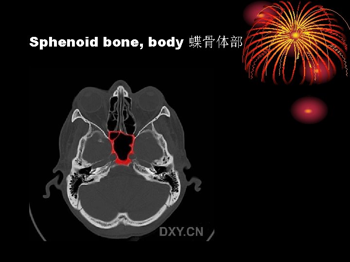 Sphenoid bone, body 蝶骨体部 