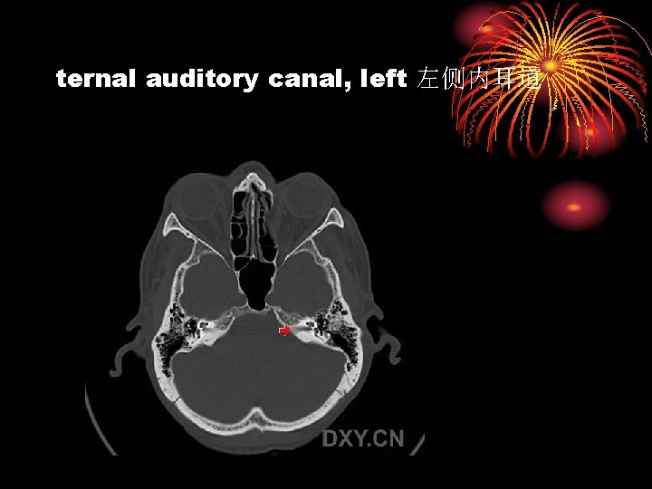 ternal auditory canal, left 左侧内耳道 