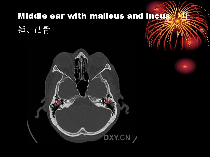 Middle ear with malleus and incus 中耳 锤、砧骨 