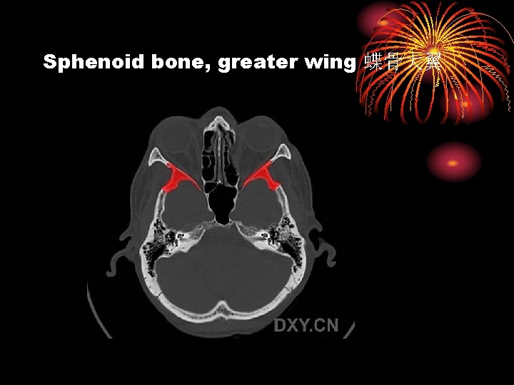 Sphenoid bone, greater wing 蝶骨大翼 