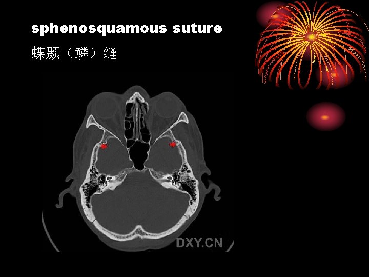 sphenosquamous suture 蝶颞（鳞）缝 