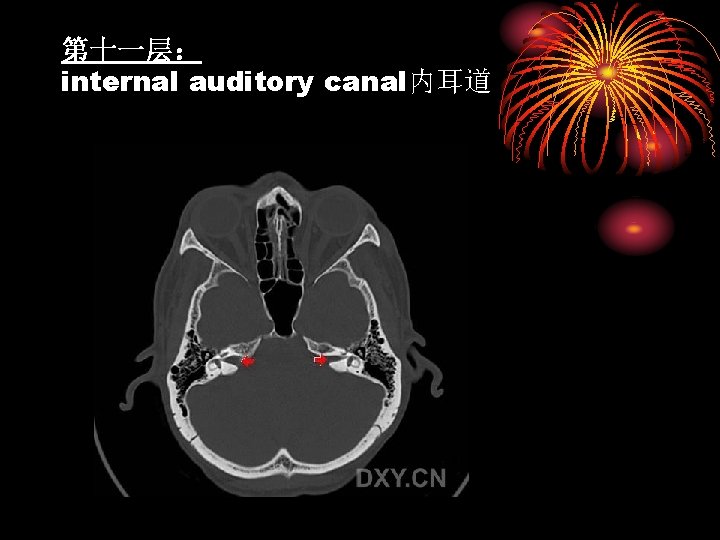 第十一层： internal auditory canal内耳道 