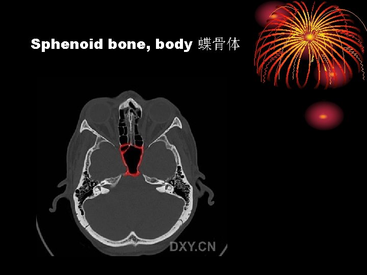 Sphenoid bone, body 蝶骨体 