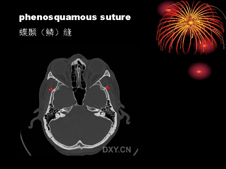 phenosquamous suture 蝶颞（鳞）缝 