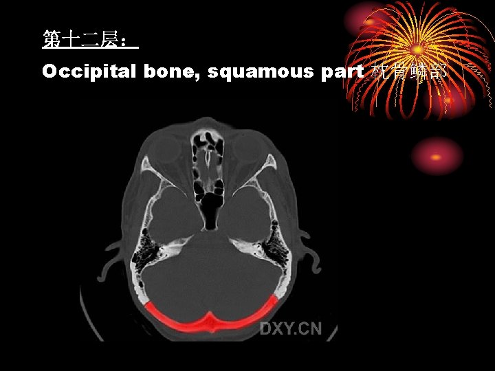 第十二层： Occipital bone, squamous part 枕骨鳞部 