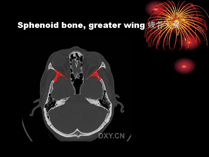 Sphenoid bone, greater wing 蝶骨大翼 