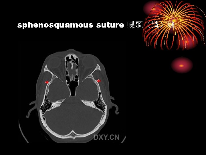 sphenosquamous suture 蝶颞（鳞）缝 