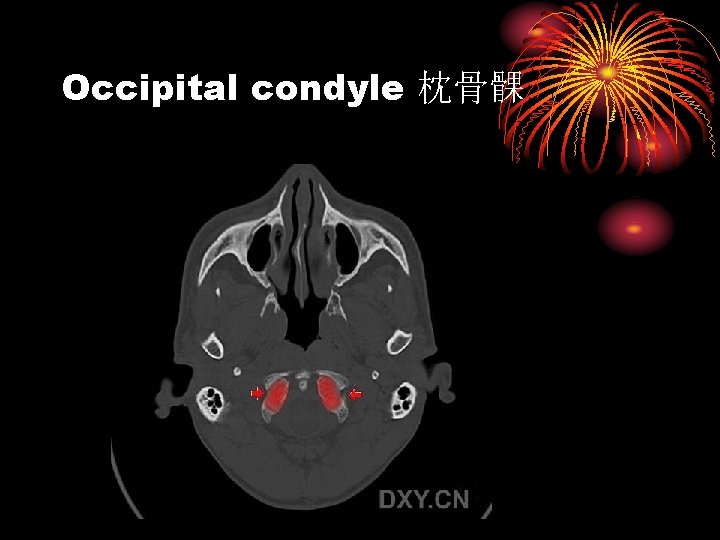 Occipital condyle 枕骨髁 