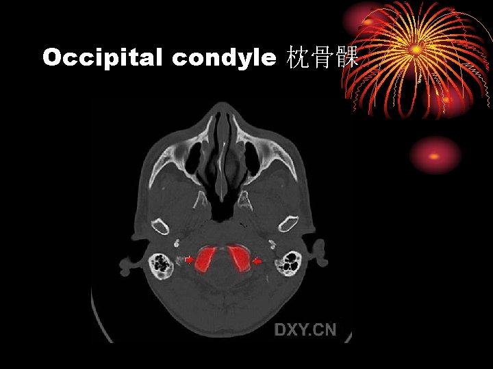 Occipital condyle 枕骨髁 