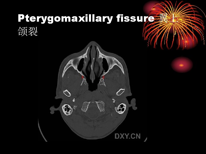 Pterygomaxillary fissure 翼上 颌裂 