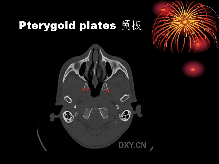 Pterygoid plates 翼板 